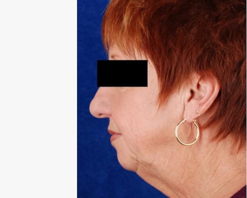 Face Lift Before & After Gallery - Patient 783930 - Image 3