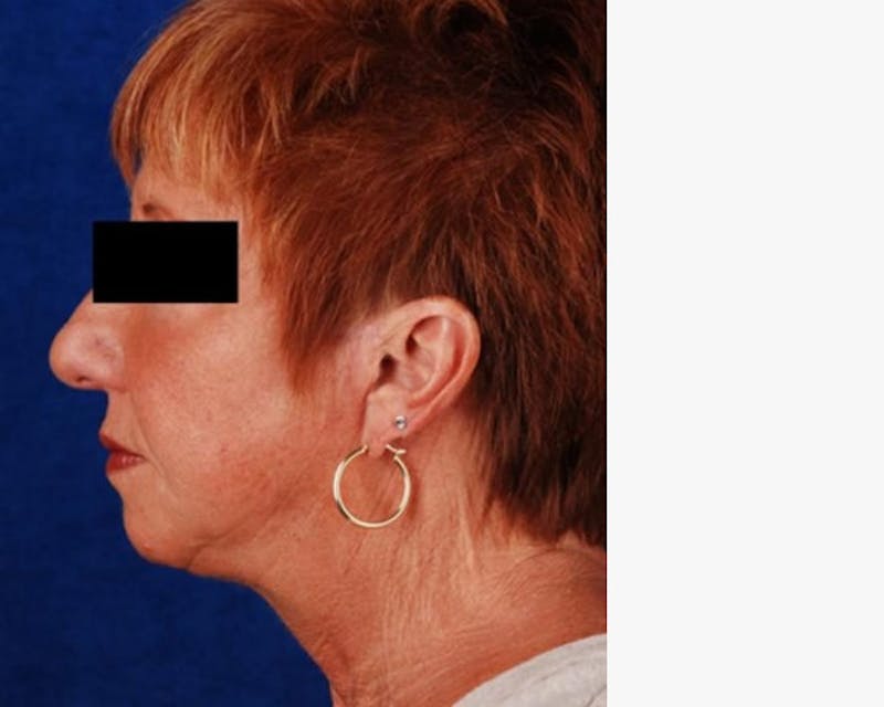 Face Lift Before & After Gallery - Patient 783930 - Image 4