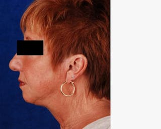 Face Lift Before & After Gallery - Patient 783930 - Image 4