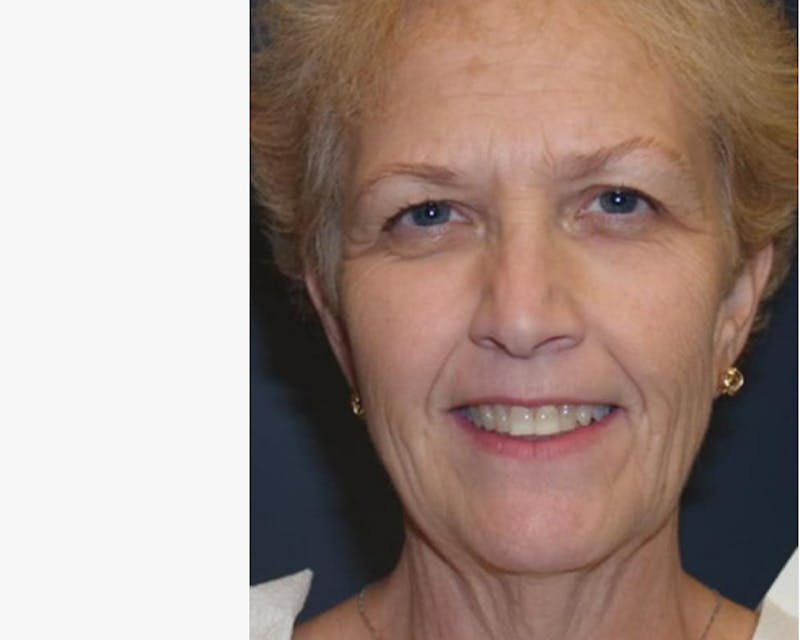 Face Lift Before & After Gallery - Patient 382181 - Image 1