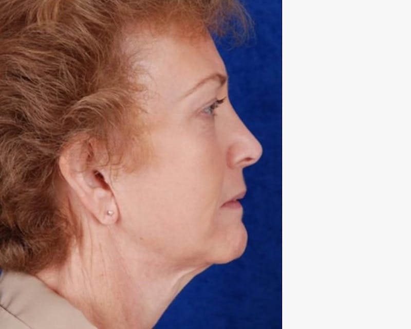 Face Lift Before & After Gallery - Patient 382181 - Image 4