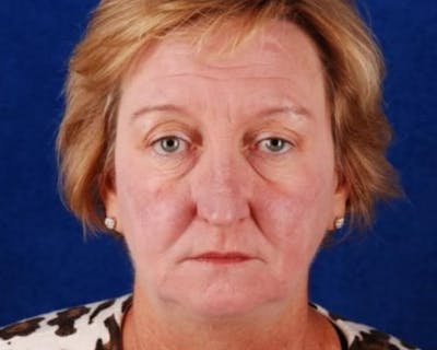 Mini Face Lift Before & After Gallery - Patient 109016 - Image 1