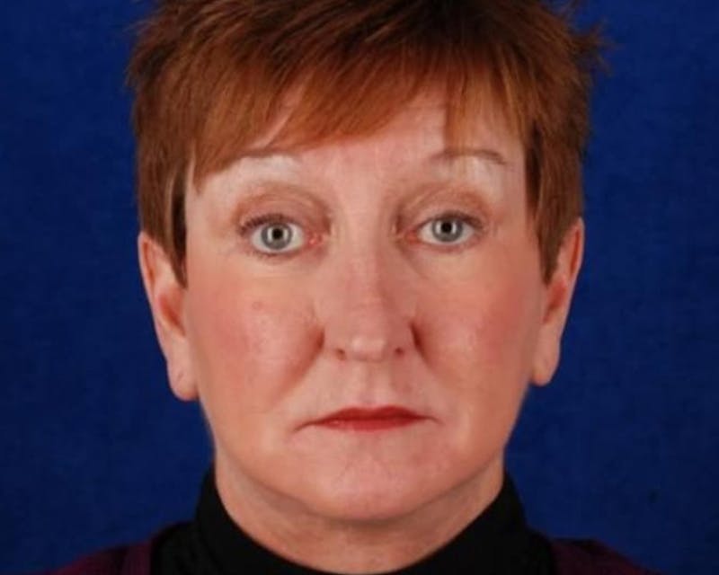 Mini Face Lift Before & After Gallery - Patient 109016 - Image 2