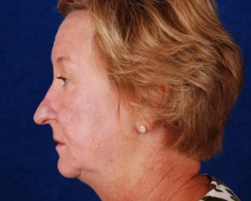 Mini Face Lift Before & After Gallery - Patient 109016 - Image 3