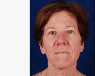 Mini Face Lift Before & After Gallery - Patient 759411 - Image 1