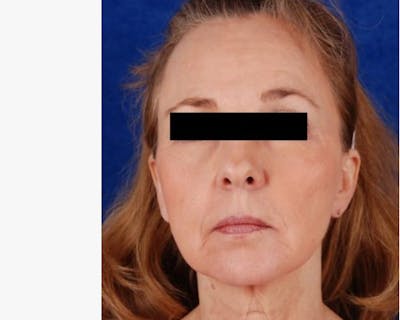 Mini Face Lift Before & After Gallery - Patient 125919 - Image 1