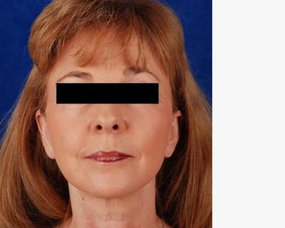 Mini Face Lift Before & After Gallery - Patient 125919 - Image 2