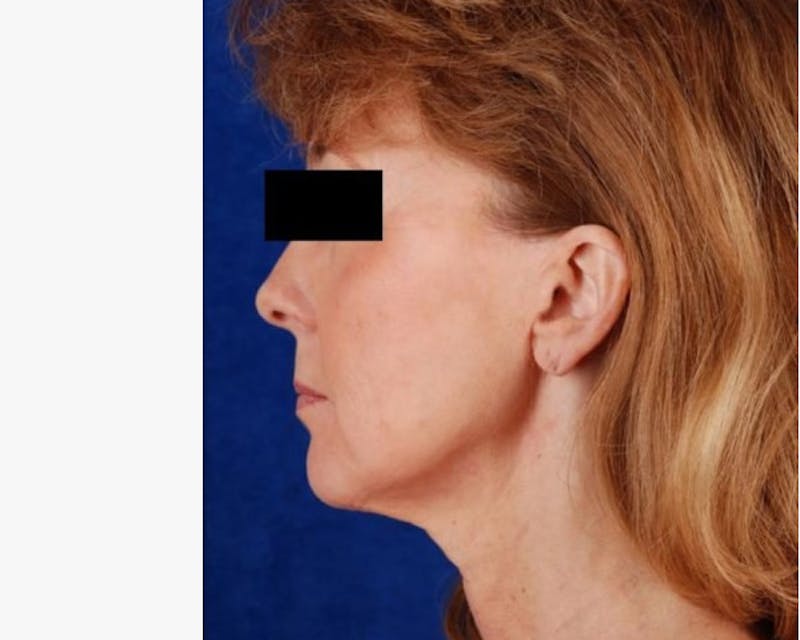 Mini Face Lift Before & After Gallery - Patient 125919 - Image 3