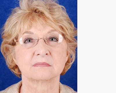 Mini Face Lift Before & After Gallery - Patient 235789 - Image 2