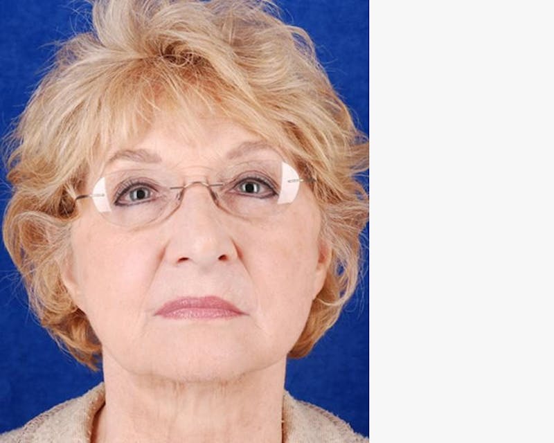 Mini Face Lift Before & After Gallery - Patient 235789 - Image 2