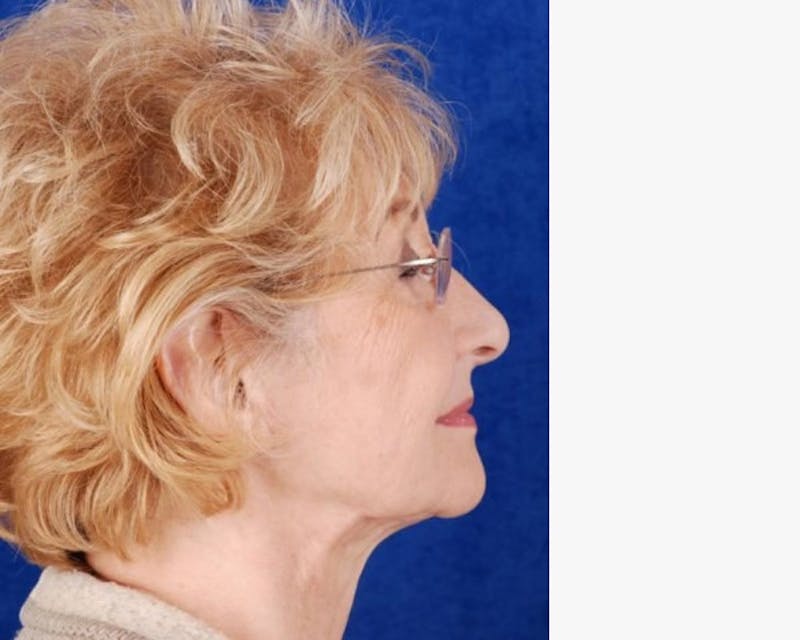 Mini Face Lift Before & After Gallery - Patient 235789 - Image 4