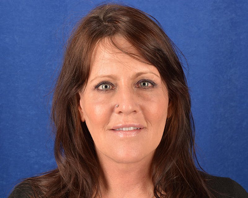 Mini Face Lift Before & After Gallery - Patient 683438 - Image 2