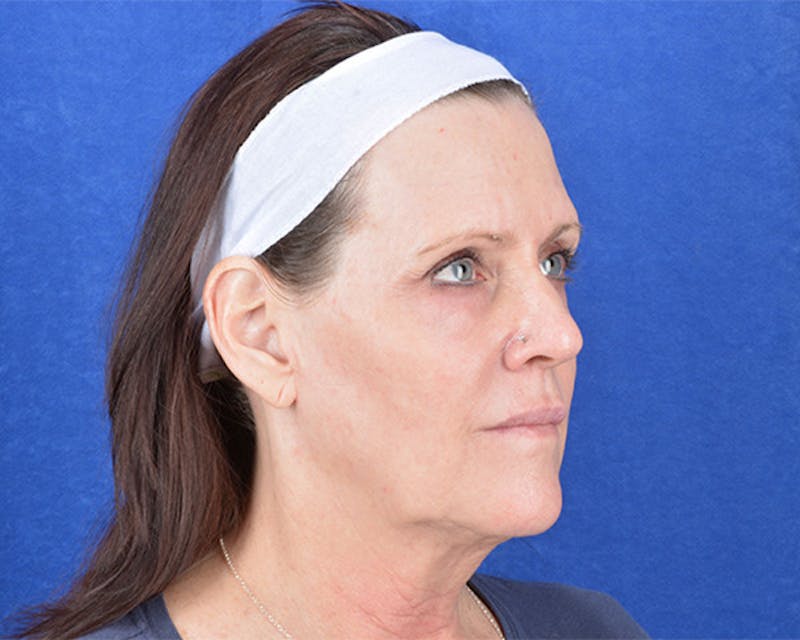 Mini Face Lift Before & After Gallery - Patient 683438 - Image 5