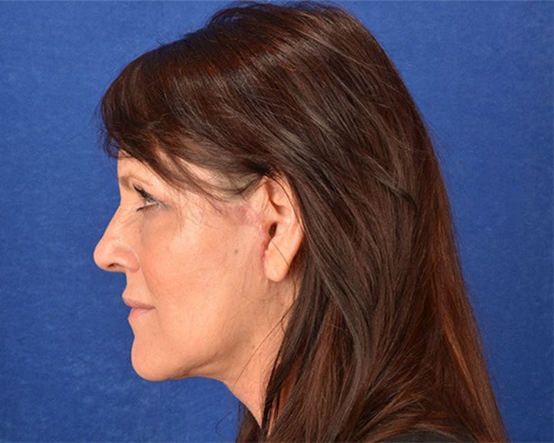 Mini Face Lift Before & After Gallery - Patient 683438 - Image 8