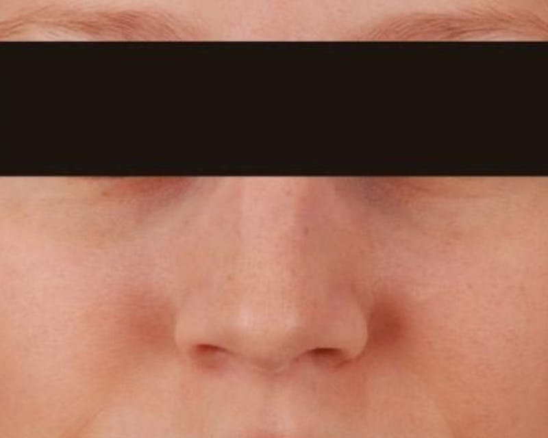 Rhinoplasty Before & After Gallery - Patient 136725 - Image 1