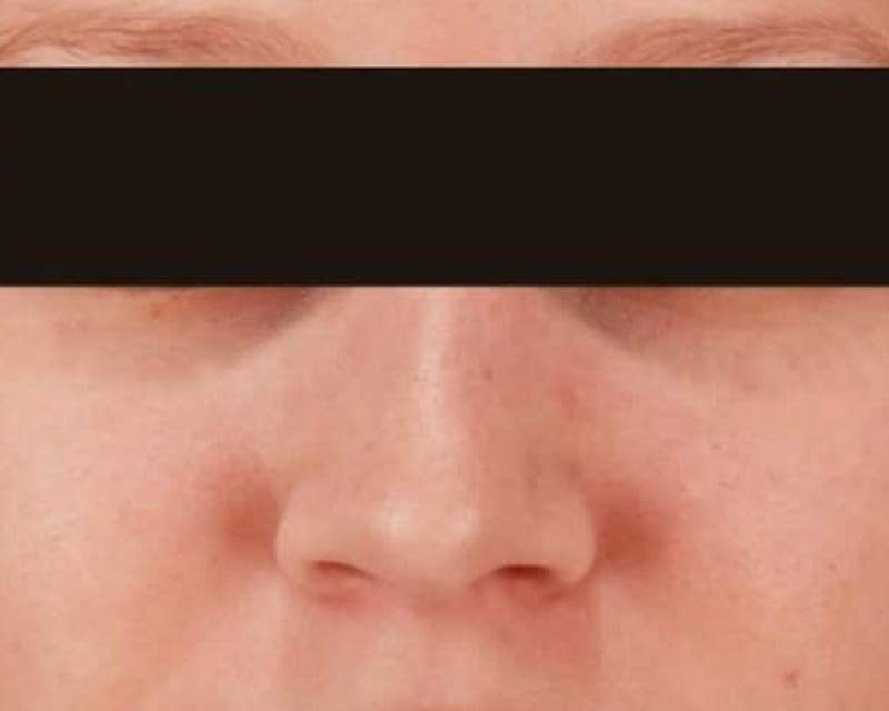 Rhinoplasty Before & After Gallery - Patient 136725 - Image 2