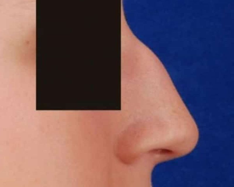 Rhinoplasty Before & After Gallery - Patient 136725 - Image 3