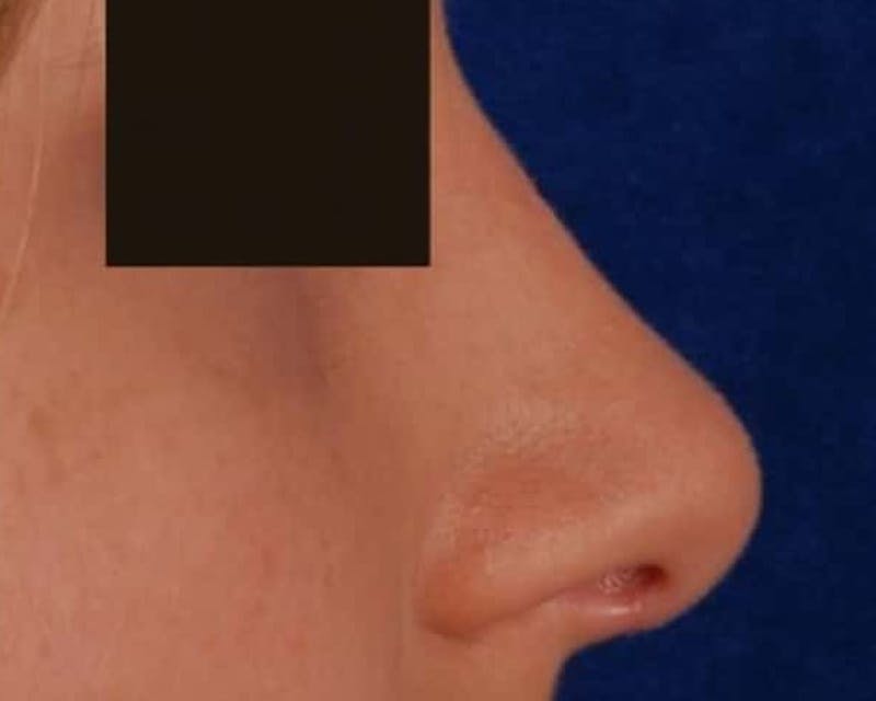 Rhinoplasty Before & After Gallery - Patient 240190 - Image 4