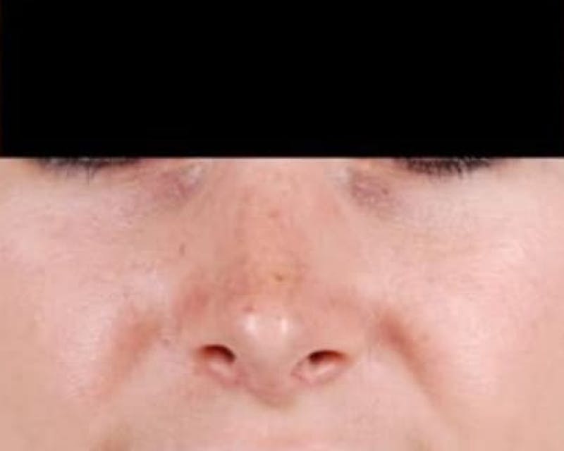 Rhinoplasty Before & After Gallery - Patient 156182 - Image 4