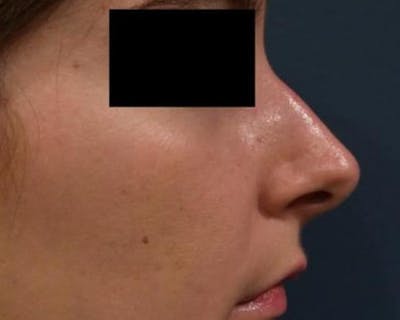 Rhinoplasty Before & After Gallery - Patient 156182 - Image 1