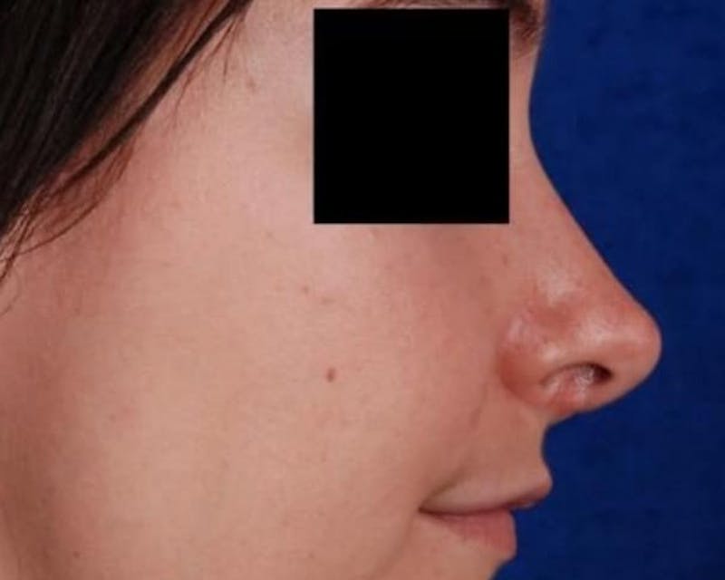 Rhinoplasty Before & After Gallery - Patient 156182 - Image 2