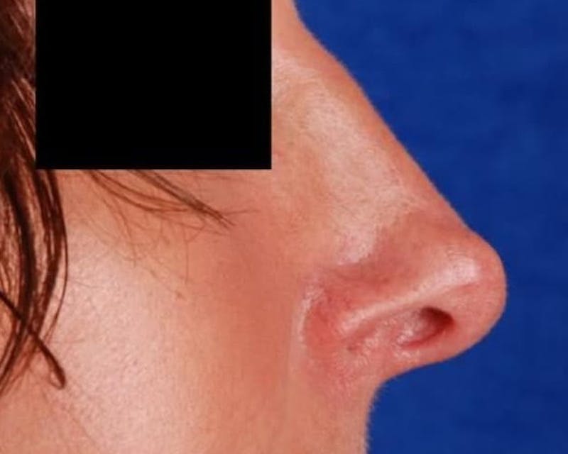 Mini Face Lift Before & After Gallery - Patient 369774 - Image 4