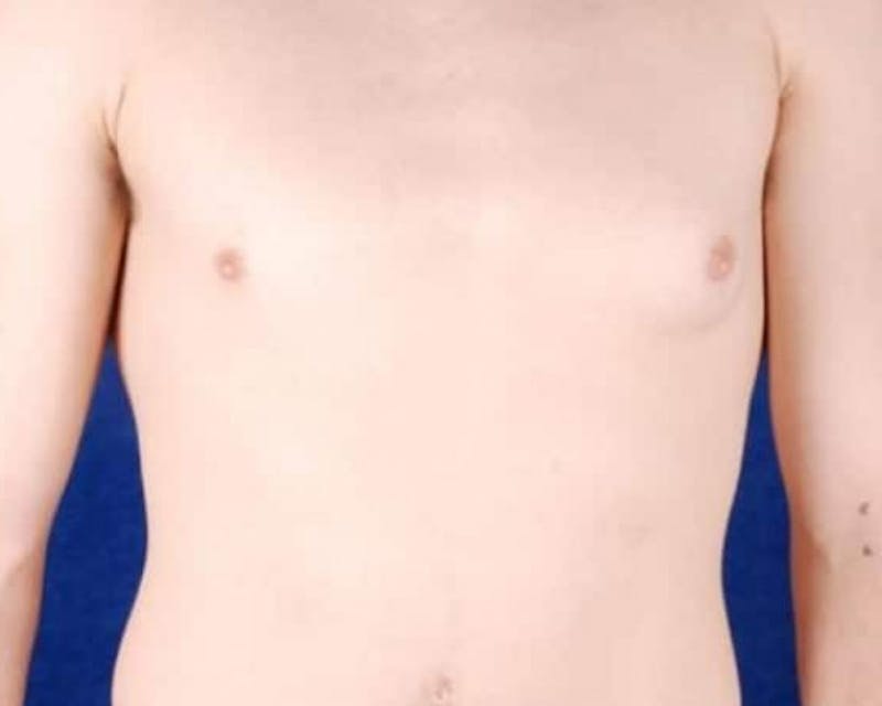 Male Breast Reduction Before & After Gallery - Patient 291000 - Image 1