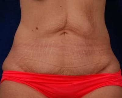 Massive Weight Loss Procedures Before & After Gallery - Patient 233673 - Image 1