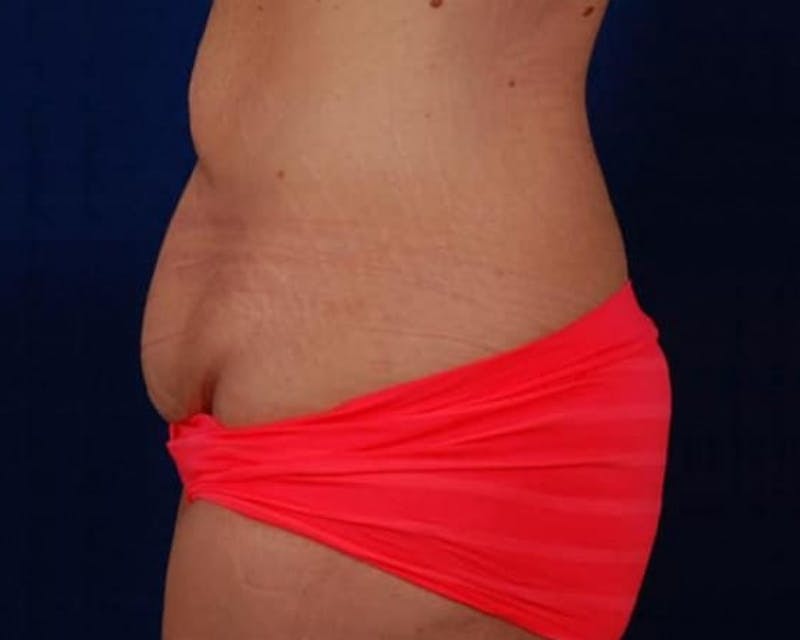Massive Weight Loss Procedures Before & After Gallery - Patient 233673 - Image 3