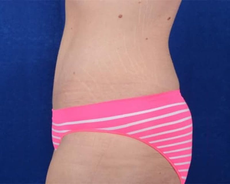Massive Weight Loss Procedures Before & After Gallery - Patient 233673 - Image 4