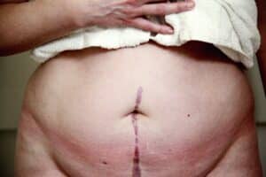 Abdominoplasty