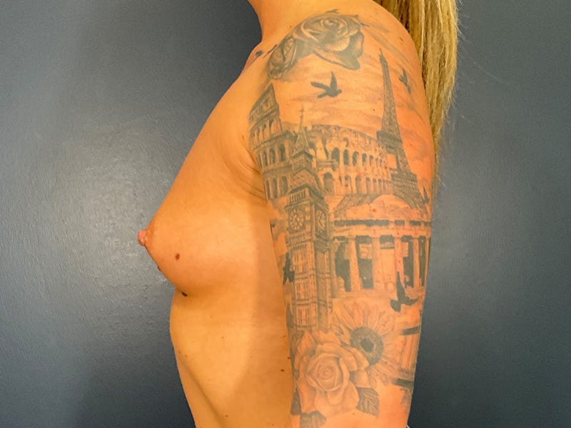 Breast Augmentation Before & After Gallery - Patient 187427 - Image 5