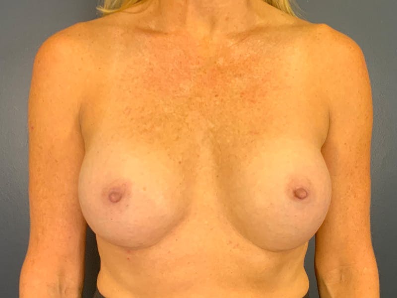 Breast Lift Before & After Gallery - Patient 163413 - Image 2