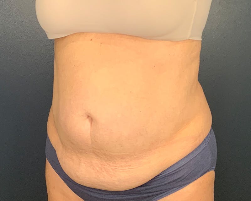 Tummy Tuck Before & After Gallery - Patient 170264 - Image 3