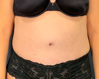 Tummy Tuck Before & After Gallery - Patient 312604 - Image 2