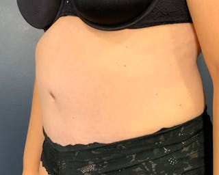 Tummy Tuck Before & After Gallery - Patient 312604 - Image 4
