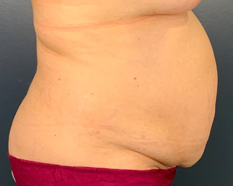 Tummy Tuck Before & After Gallery - Patient 312604 - Image 5