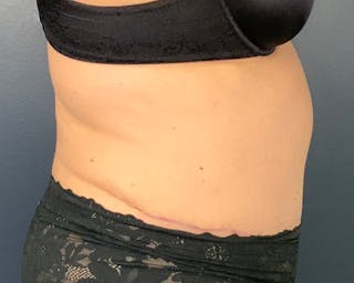 Tummy Tuck Before & After Gallery - Patient 312604 - Image 6