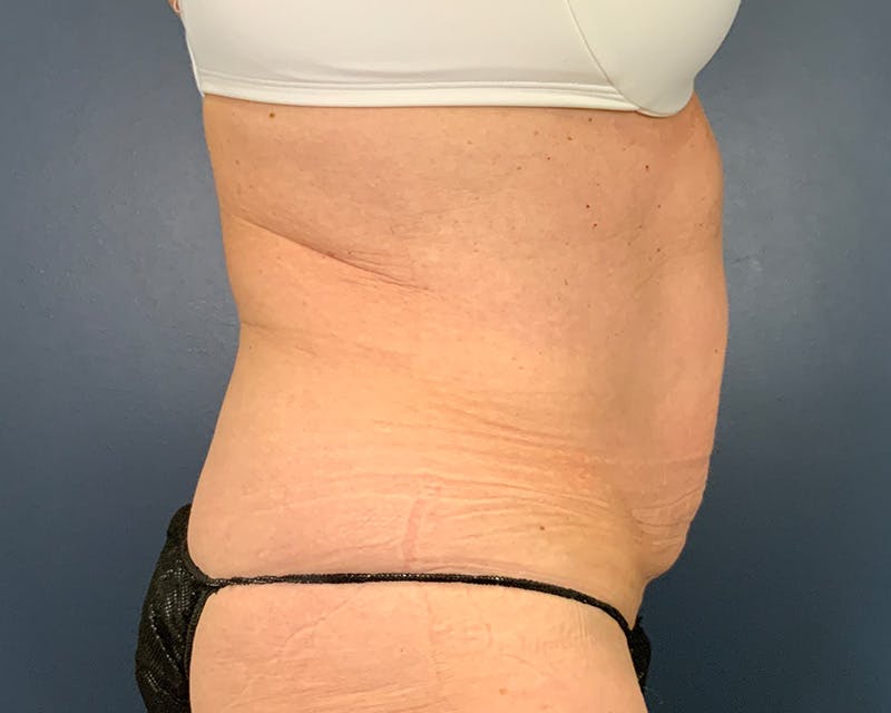 Tummy Tuck Before & After Gallery - Patient 115080 - Image 3