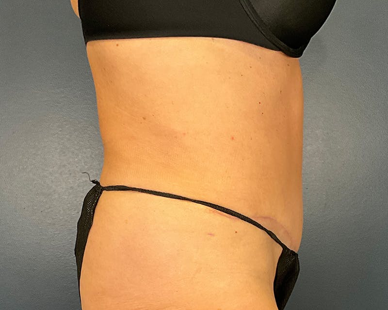 Tummy Tuck Before & After Gallery - Patient 115080 - Image 4