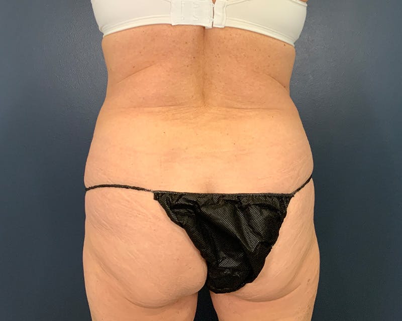 Tummy Tuck Before & After Gallery - Patient 115080 - Image 7