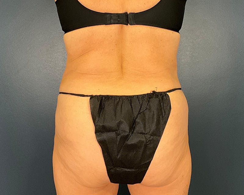 Tummy Tuck Before & After Gallery - Patient 115080 - Image 8