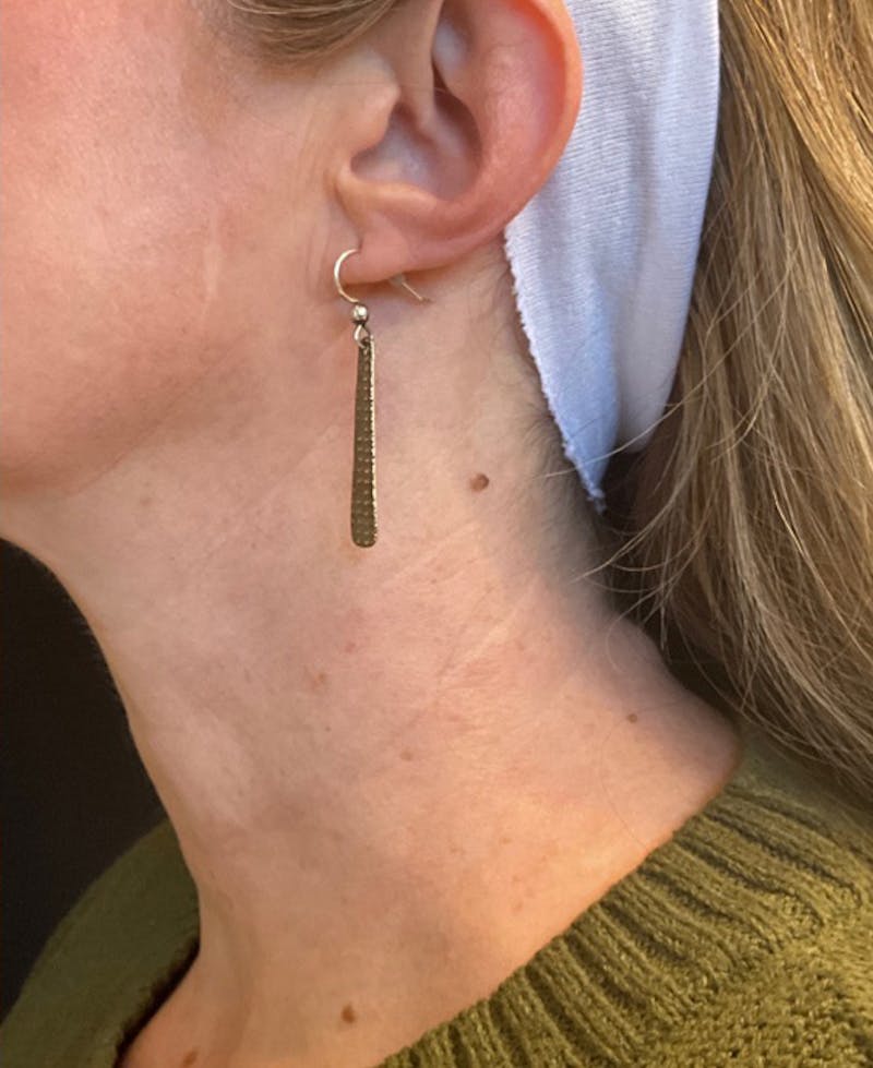 SkinPen Before & After Gallery - Patient 289185 - Image 2