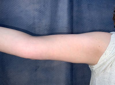 Arm Lift Before & After Gallery - Patient 185200 - Image 2