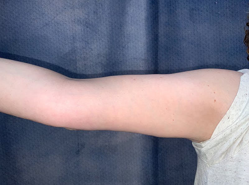 Arm Lift Before & After Gallery - Patient 185200 - Image 2