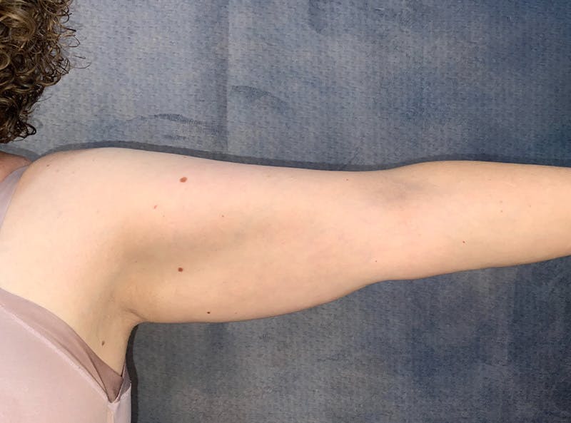 Arm Lift Before & After Gallery - Patient 185200 - Image 5