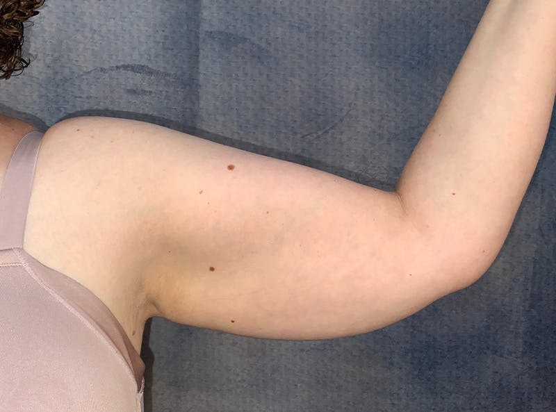 Arm Lift Before & After Gallery - Patient 185200 - Image 3