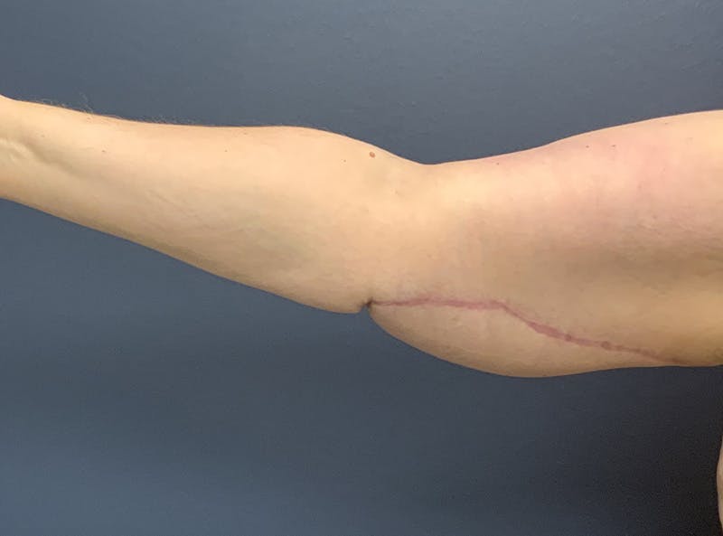 Arm Lift Before & After Gallery - Patient 275696 - Image 2