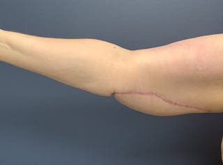 Arm Lift Before & After Gallery - Patient 275696 - Image 2