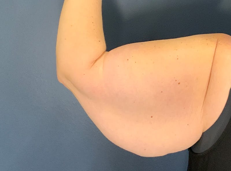 Arm Lift Before & After Gallery - Patient 275696 - Image 3